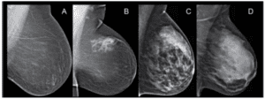 Dense Breast Tissue | Brighton Women's Health